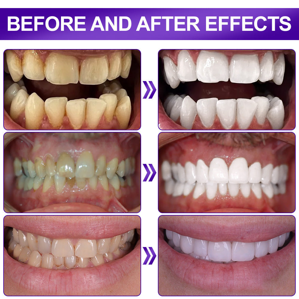 🦷𝐅𝐥𝐲𝐬𝐦𝐮𝐬® 𝐕𝟑𝟒 𝐖𝐇𝐈𝐓𝐄𝐍𝐈𝐍𝐆 𝐒𝐓𝐑𝐈𝐏𝐒 — Clinically proven to gently remove stains, whiten teeth, and restore natural brightness in just 30 minutes — safe for sensitive teeth and gums.