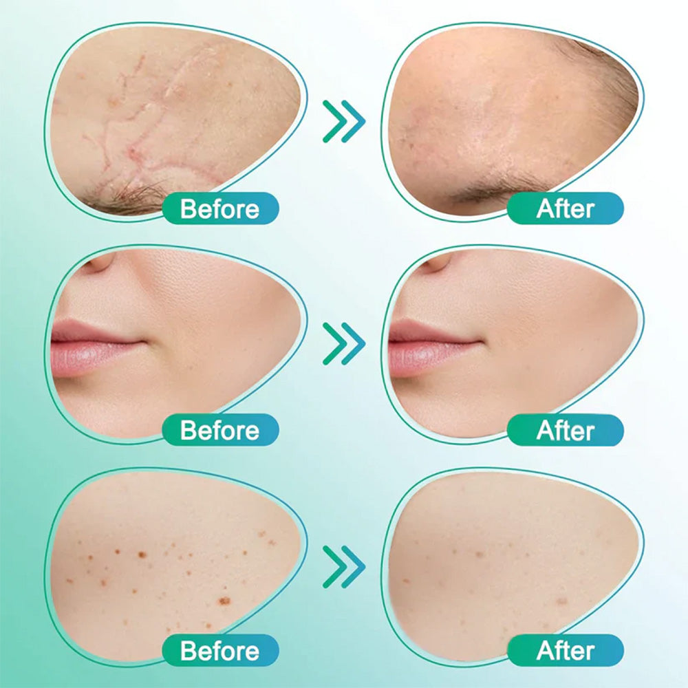 🩹GLANARIVA® 3-in-1 Microneedle Treatment Patch for Scars, Wrinkles & Dark Spots
